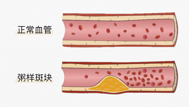 血栓是心梗、腦梗的元兇，很容易找上這些人