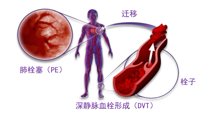 骨科術(shù)后重點(diǎn)關(guān)注的問題—VTE，該如何防治？