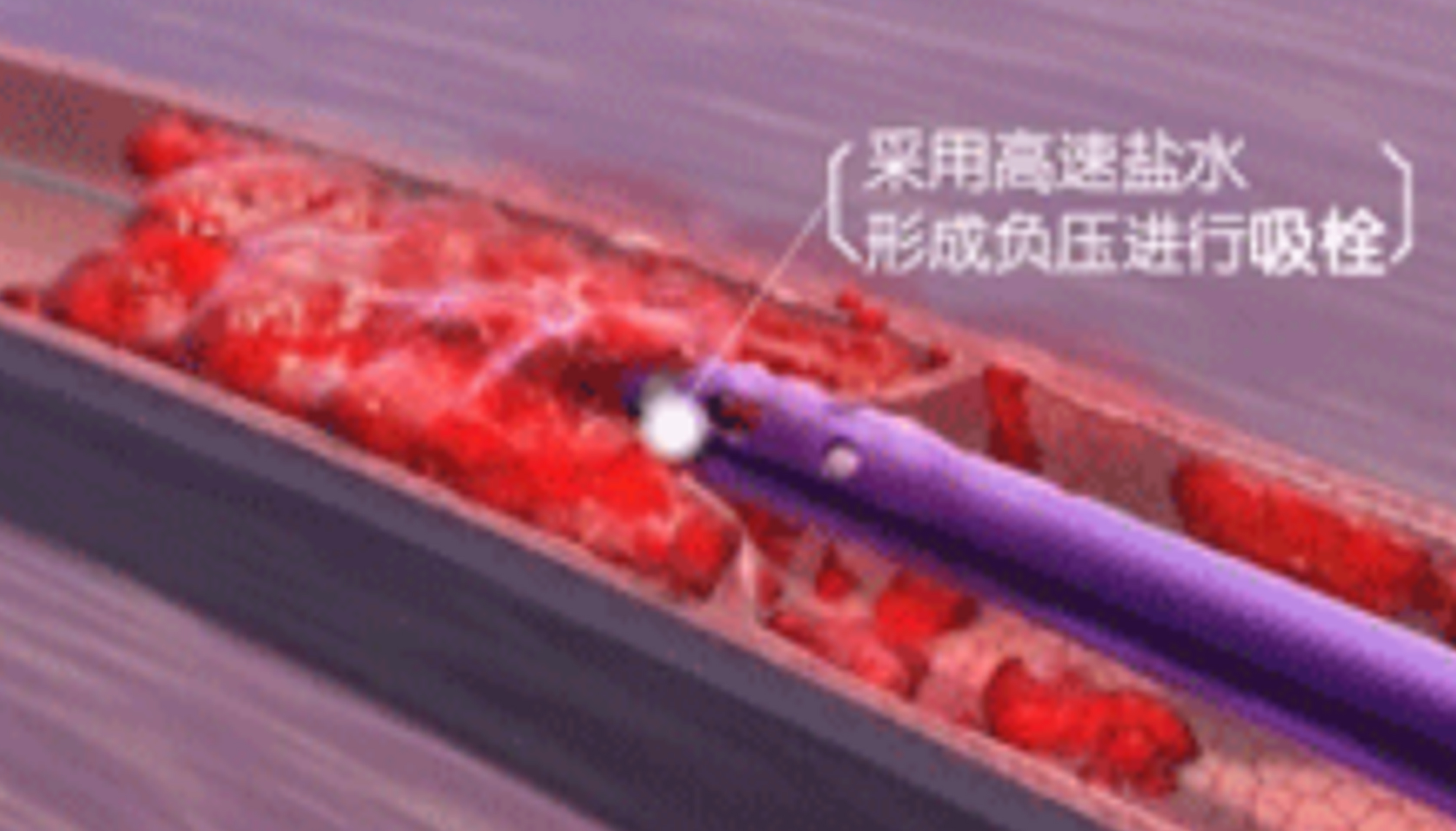 深靜脈血栓能致命，防治“大法”要了解！