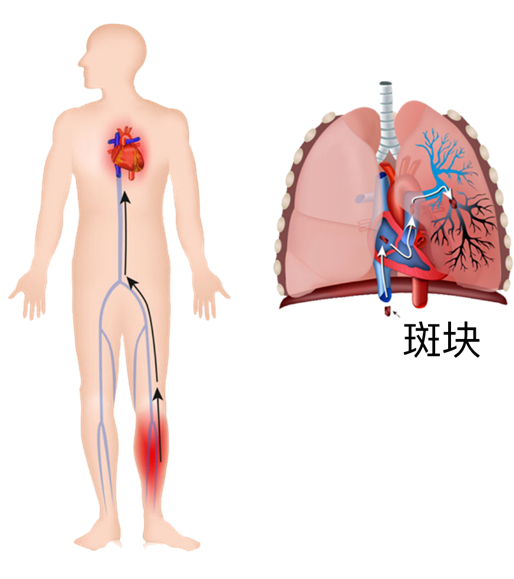 血栓是心梗、腦梗的元兇，很容易找上這些人