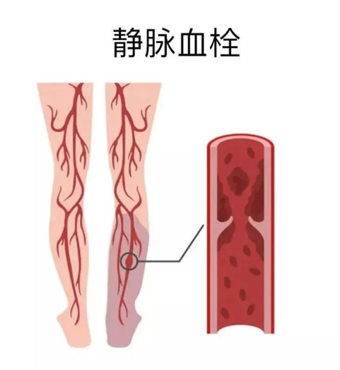 血栓是心梗、腦梗的元兇，很容易找上這些人
