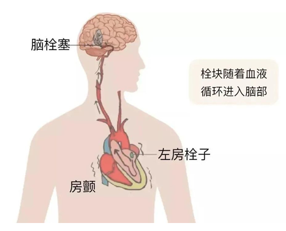 血栓是心梗、腦梗的元兇，很容易找上這些人