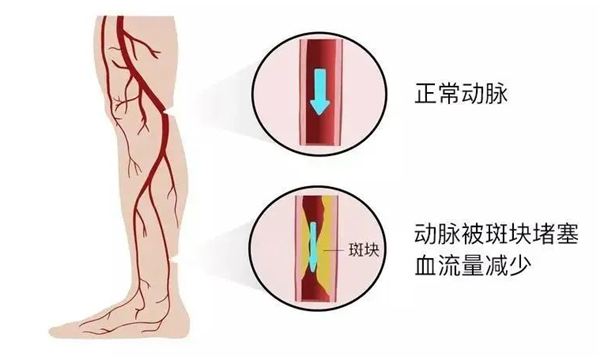 血栓是心梗、腦梗的元兇，很容易找上這些人