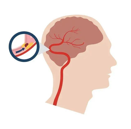 血栓是心梗、腦梗的元兇，很容易找上這些人