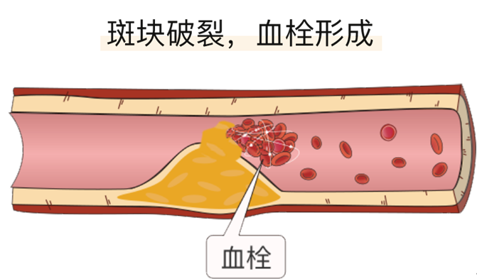 血栓是心梗、腦梗的元兇，很容易找上這些人