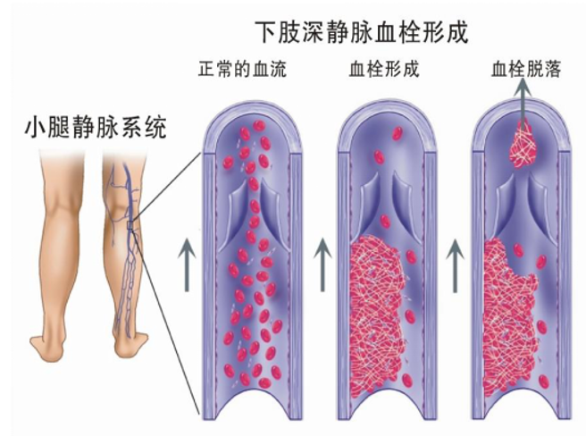 警惕！這個(gè)全球“第三大心血管殺手”，我們該如何應(yīng)對？