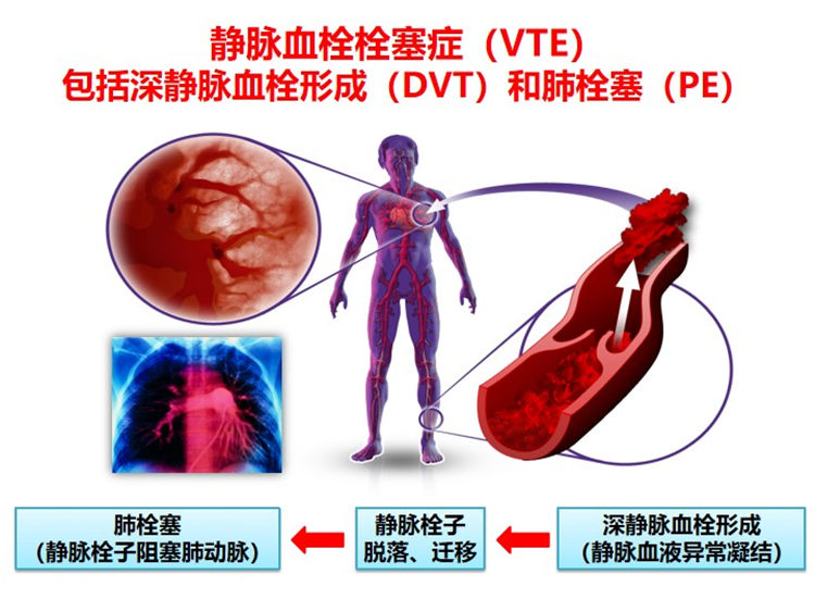 世界血栓日 | 拴不住，動起來