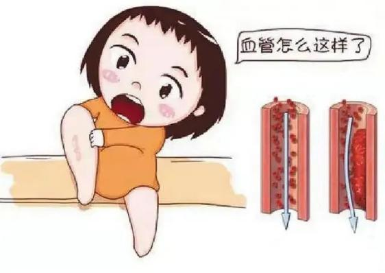腫瘤不容忽視的第二號殺手—VTE，該如何防治？