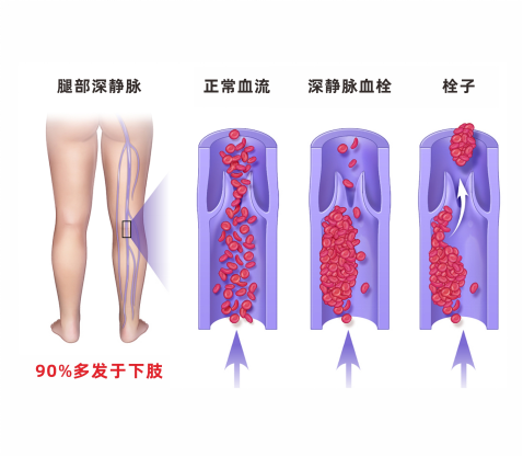 深靜脈血栓類(lèi)似病癥的認(rèn)識(shí)與區(qū)分