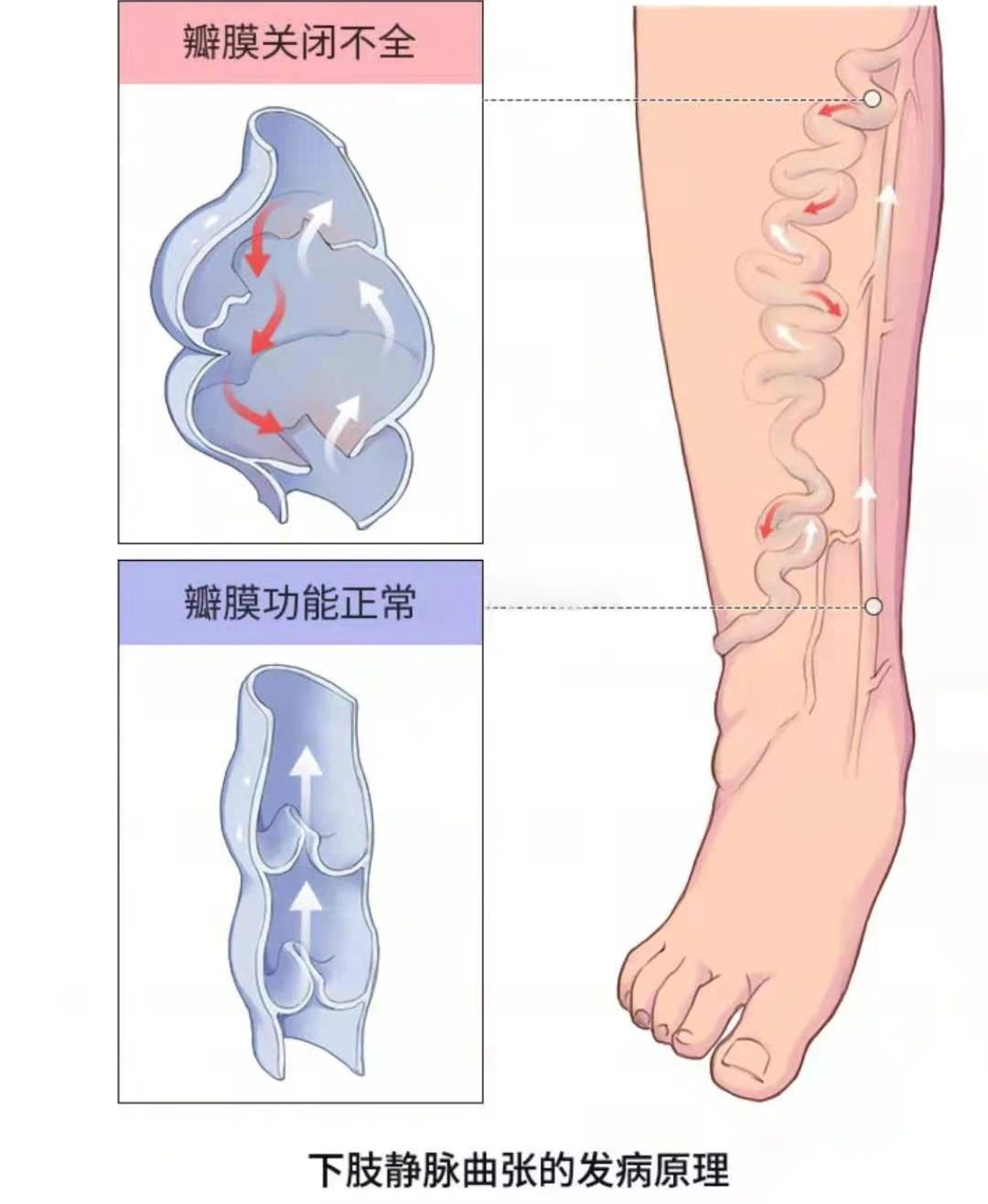深靜脈血栓類(lèi)似病癥的認(rèn)識(shí)與區(qū)分