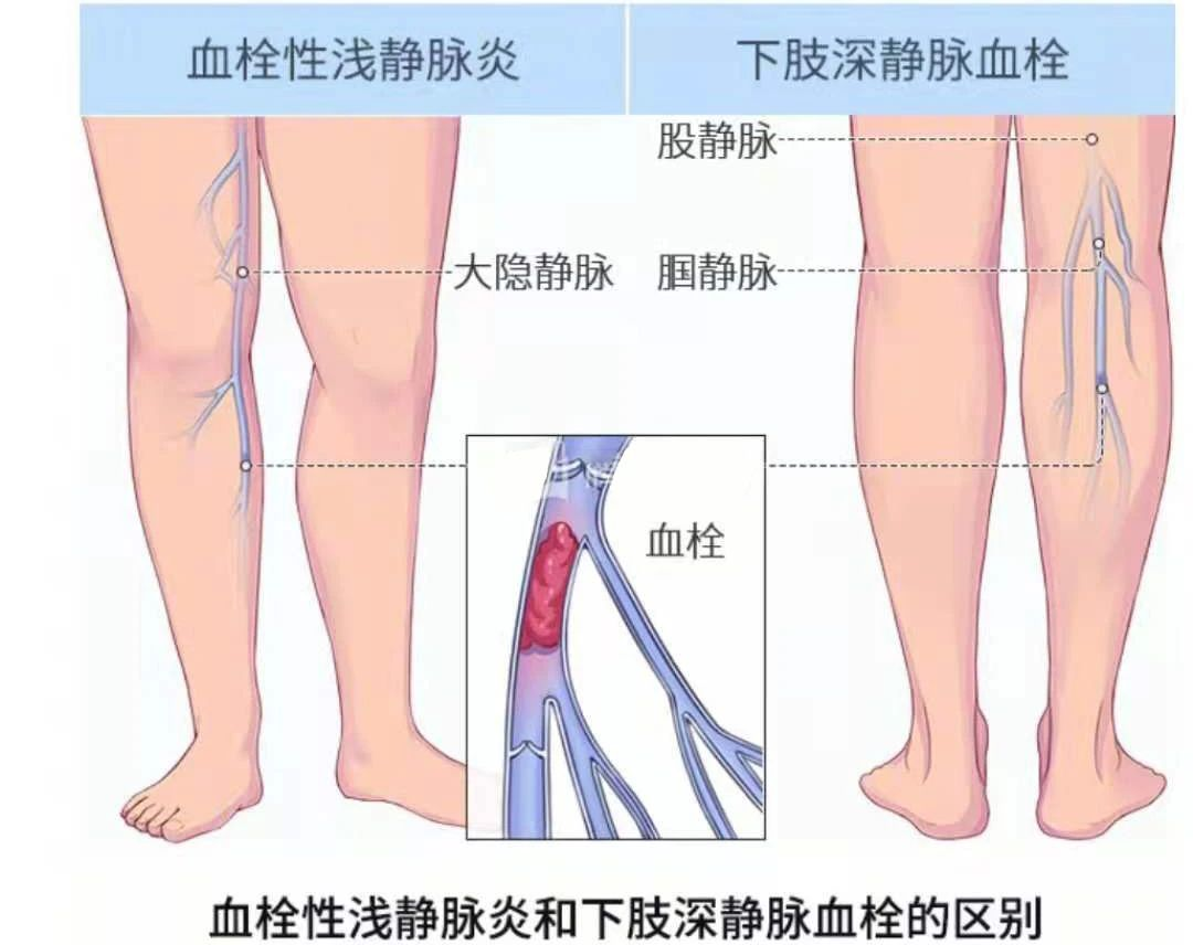 深靜脈血栓類(lèi)似病癥的認(rèn)識(shí)與區(qū)分