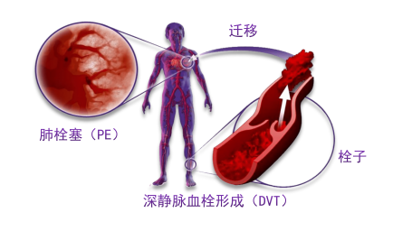 骨科術后重點關注的問題—VTE，該如何防治？