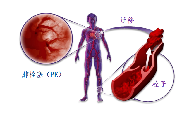 動(dòng)脈血栓和靜脈血栓有什么區(qū)別嗎？