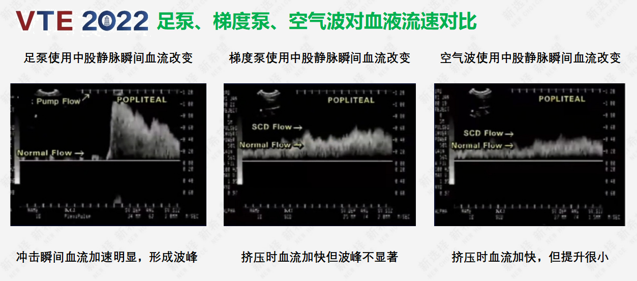 圍術(shù)期患者VTE的預(yù)防，只知道抗凝可不行