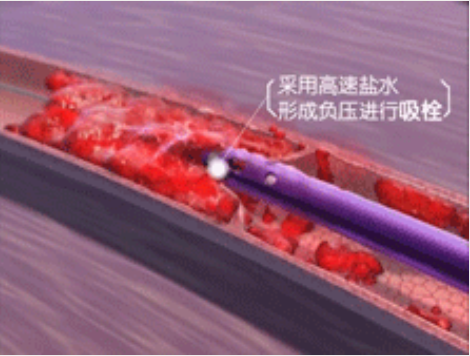 深靜脈血栓能致命，防治“大法”要了解！