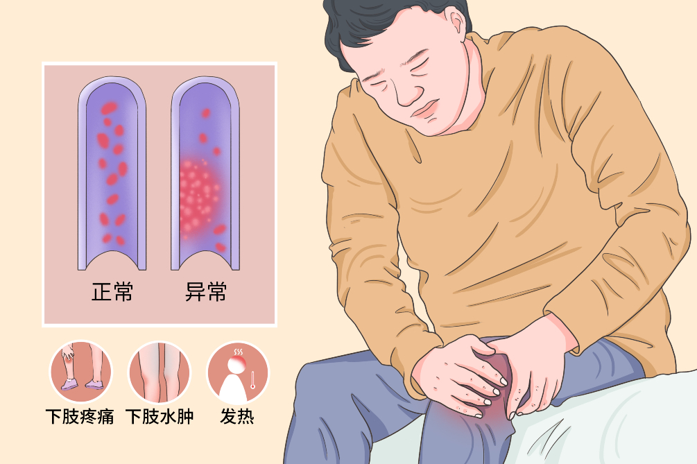 VTE的危害您了解嗎？