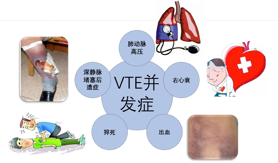 VTE的危害您了解嗎？