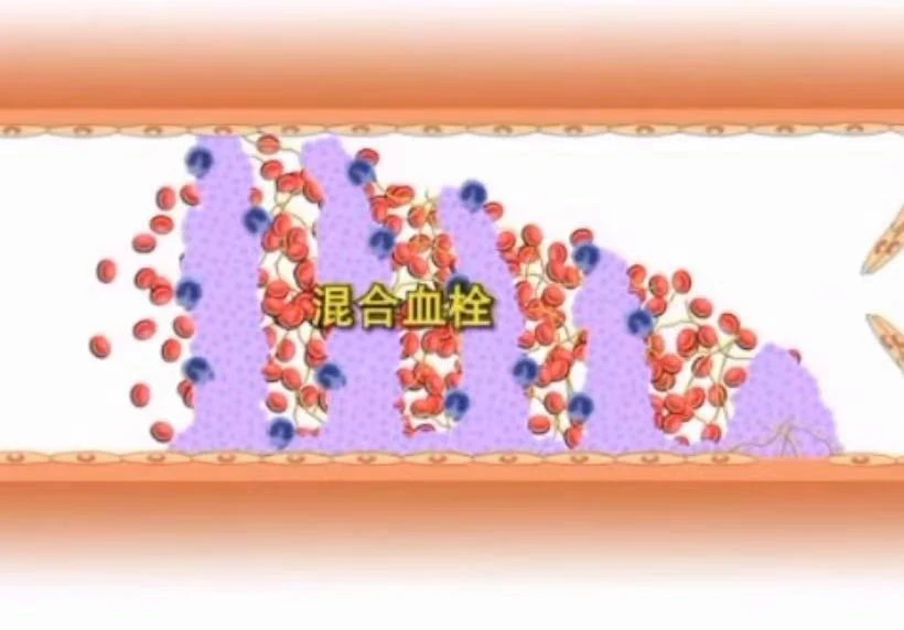 世界血栓日來(lái)臨之際 共話血栓的前世今生